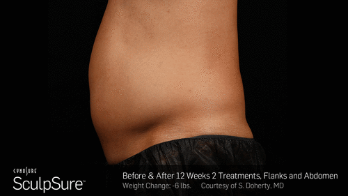 SculpSure™ Before and After Photos