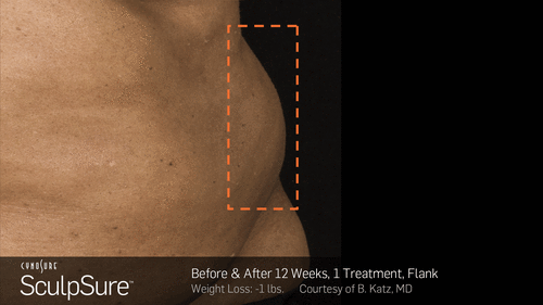 SculpSure™ Before and After Photos