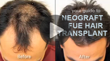 Video: Your Guide to Neograft FUE Hair Transplant 